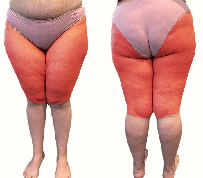 lipedema-II-tipo-giovane-donna-ragazza